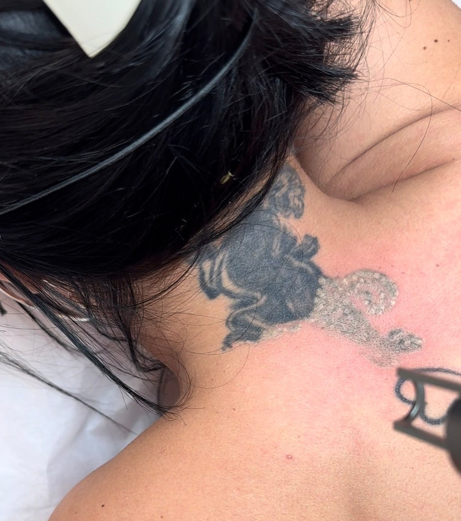 Remoción de tatuaje mediano