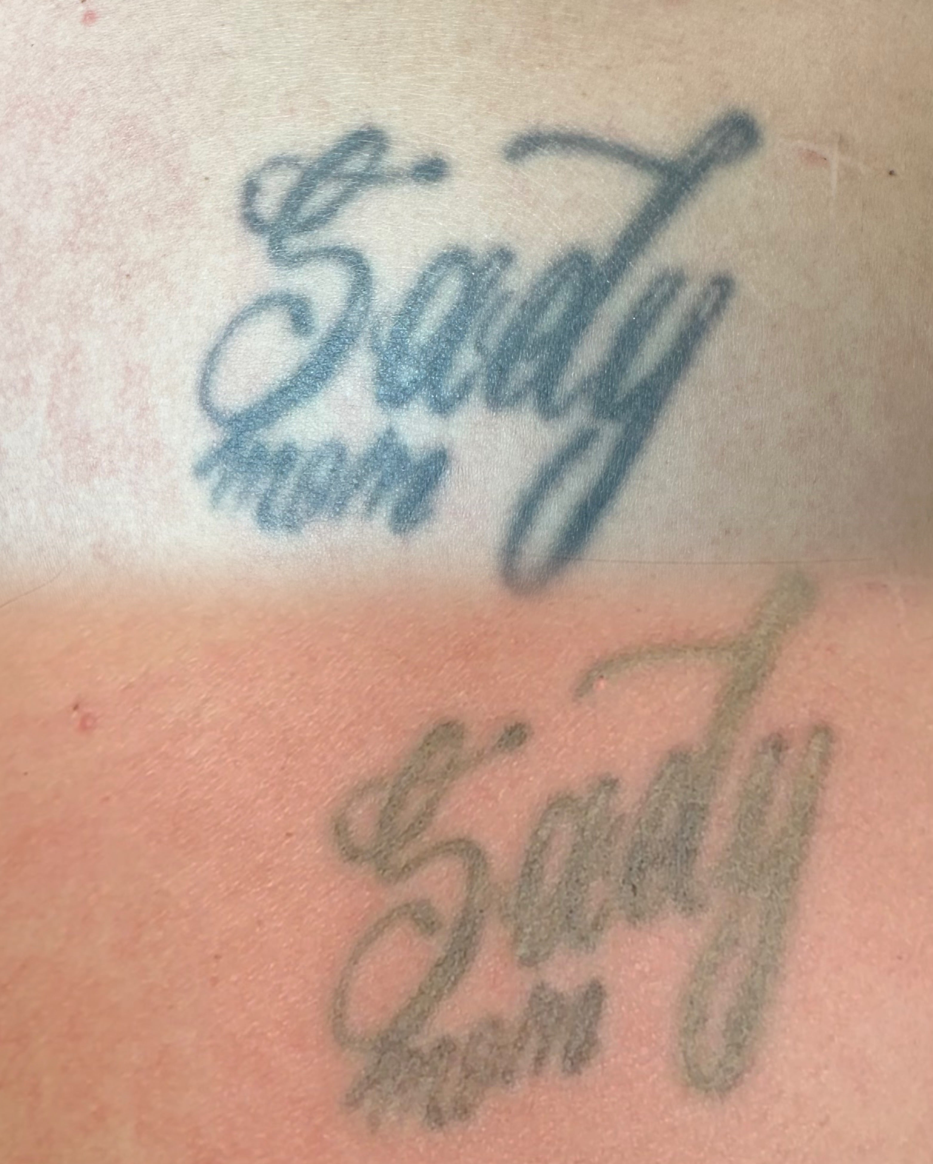 Remoción de tatuaje mediano